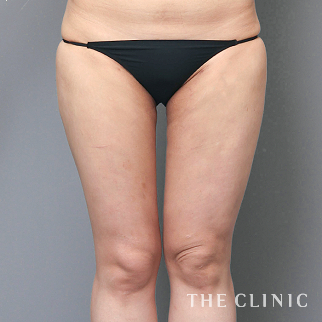 【THE CLINIC 症例画像】No.1561_2_太もも_360脂肪吸引®