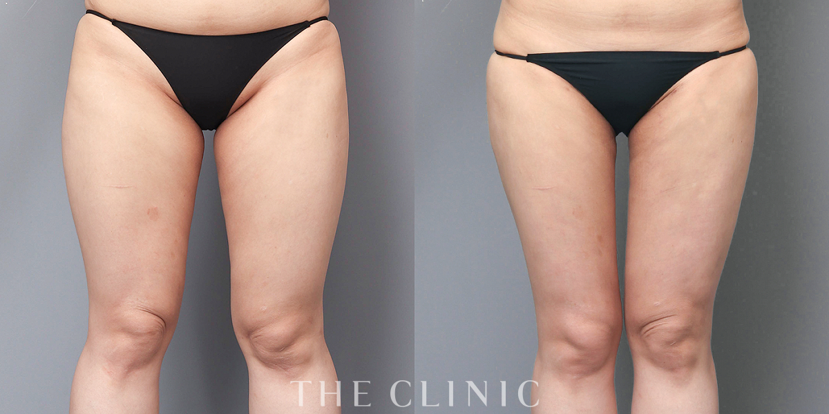 ベイザー脂肪吸引の術前/術後