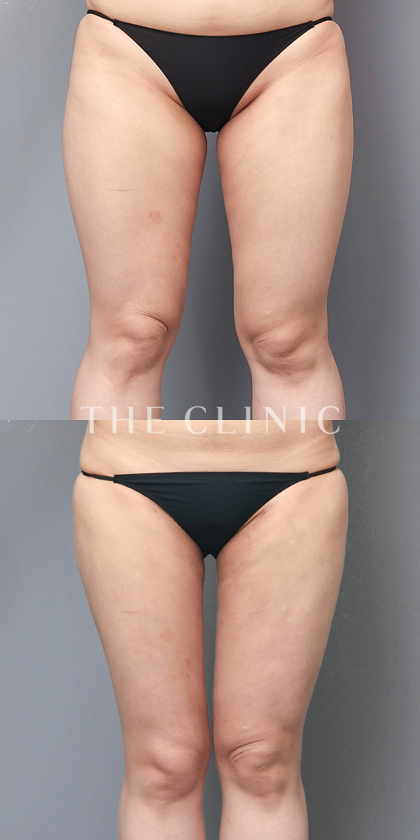 太もものベイザー脂肪吸引（29歳女性）の術前・術後写真