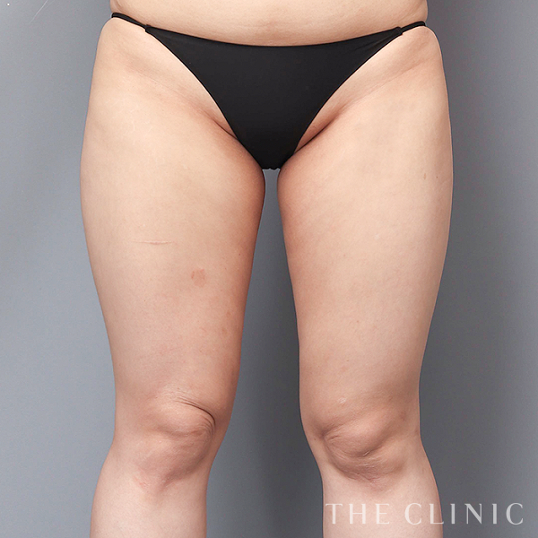 太もものベイザー脂肪吸引（29歳女性）の術前写真
