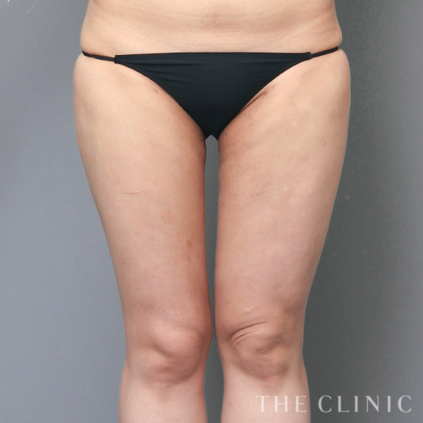 太もものベイザー脂肪吸引（29歳女性）の術後写真