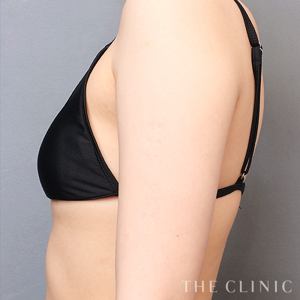 二の腕のベイザー脂肪吸引（19歳男性）の術前写真