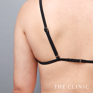 【THE CLINIC 症例画像】No.1563_2_二の腕_360脂肪吸引®