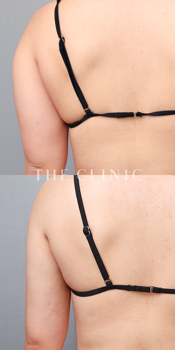 二の腕のベイザー脂肪吸引（25歳女性）の術前・術後写真