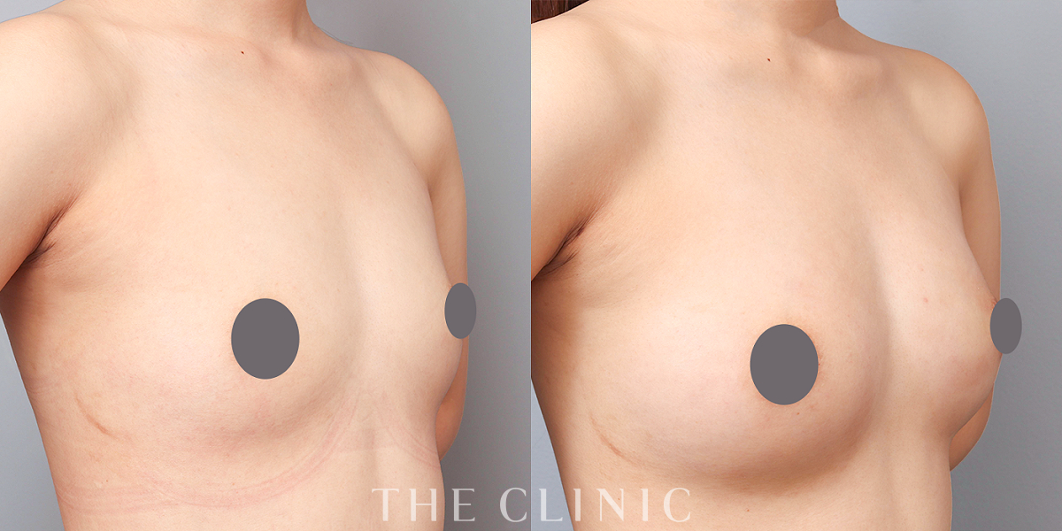 コンデンスリッチ豊胸の術前/術後