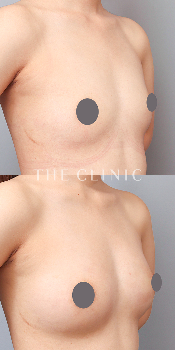 ボリュームアップのコンデンスリッチ豊胸（23歳女性）の術前・術後写真