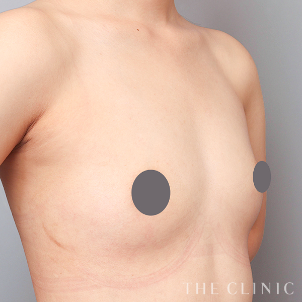 ボリュームアップのコンデンスリッチ豊胸（23歳女性）の術前写真