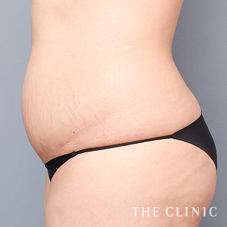 【THE CLINIC 症例画像】No.1565_1_腹部_360脂肪吸引®