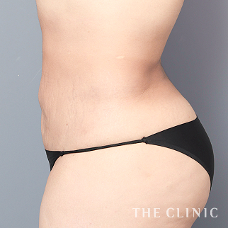 【THE CLINIC 症例画像】No.1565_2_腹部_360脂肪吸引®