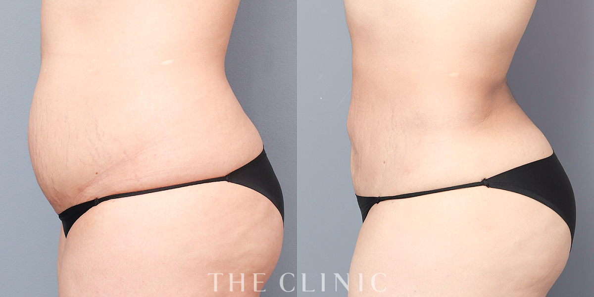 腹部のベイザー脂肪吸引（32歳女性）の術前／術後