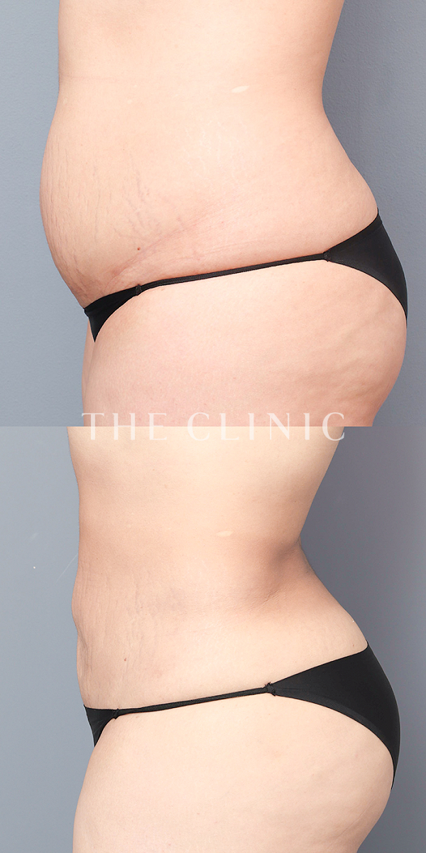 腹部のベイザー脂肪吸引（32歳女性）の術前・術後写真