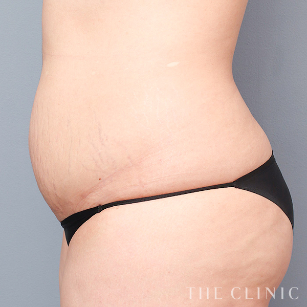 腹部のベイザー脂肪吸引（32歳女性）の術前写真