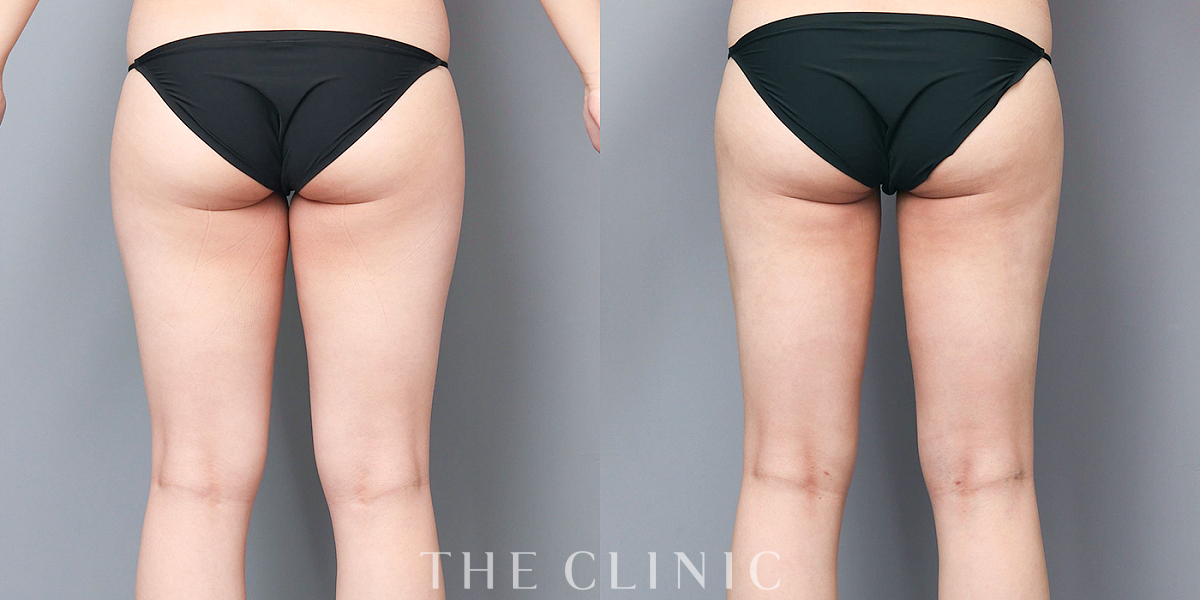 ベイザー脂肪吸引の術前/術後