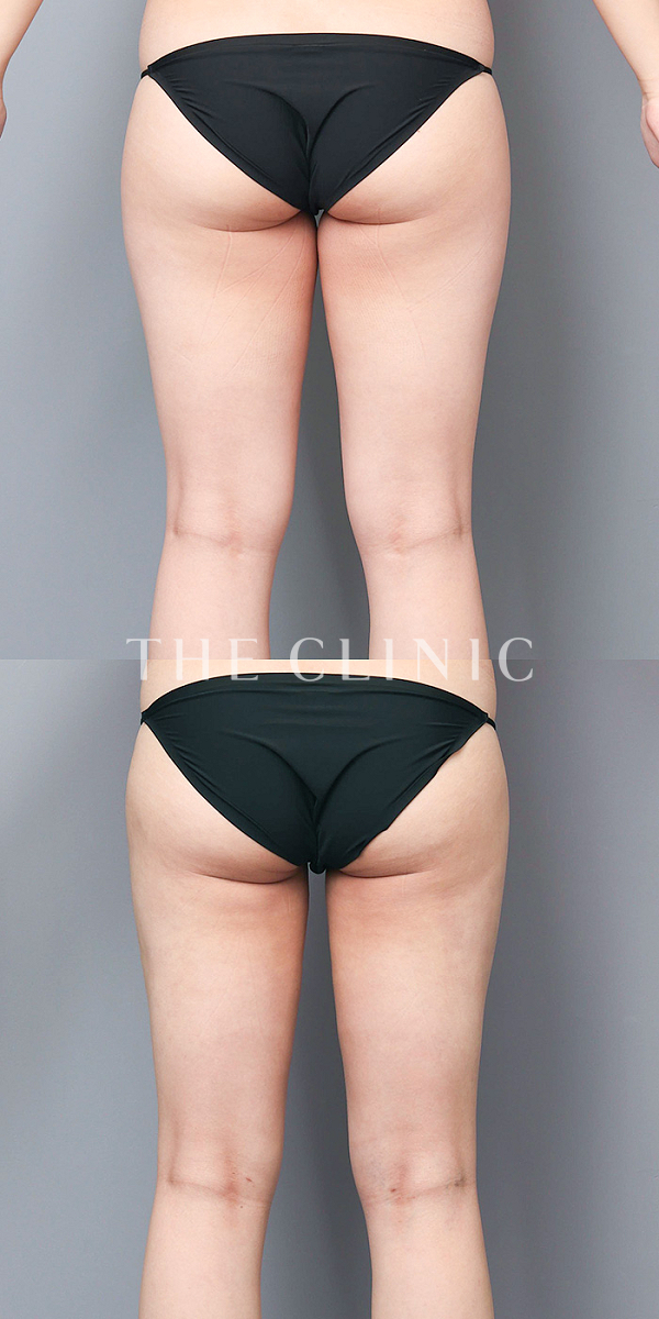 太もものベイザー脂肪吸引（24歳女性）の術前・術後写真