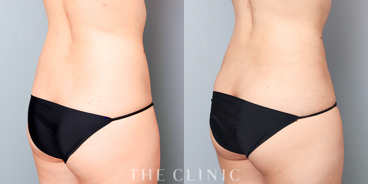 ベイザー脂肪吸引の術前/術後