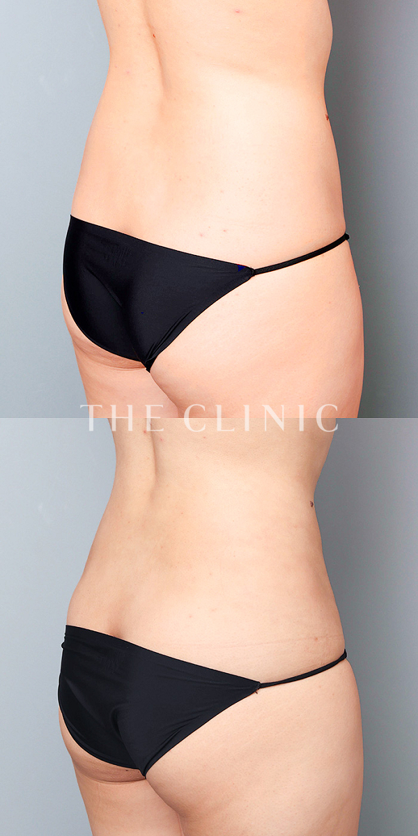 腰・ウエストのベイザー脂肪吸引（30歳女性）の術前・術後写真