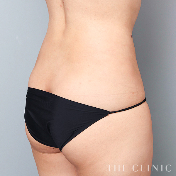腰・ウエストのベイザー脂肪吸引（30歳女性）の術後写真
