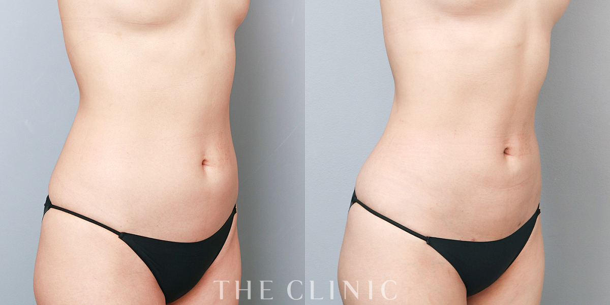 ベイザー脂肪吸引の術前/術後