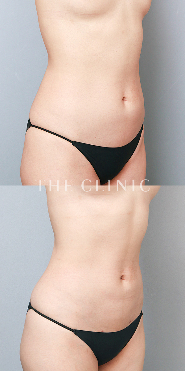 腹部のベイザー脂肪吸引（40歳女性）の術前・術後写真