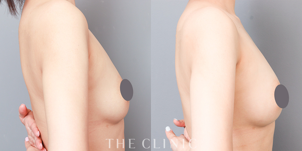 コンデンスリッチ豊胸の術前/術後