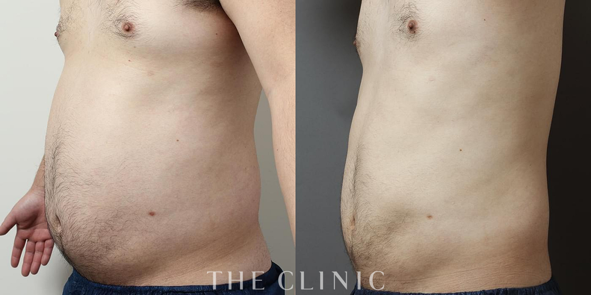 360脂肪吸引®の術前／術後