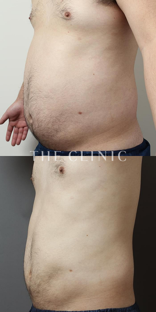 腹部の360脂肪吸引®（29歳男性）の術前・術後写真