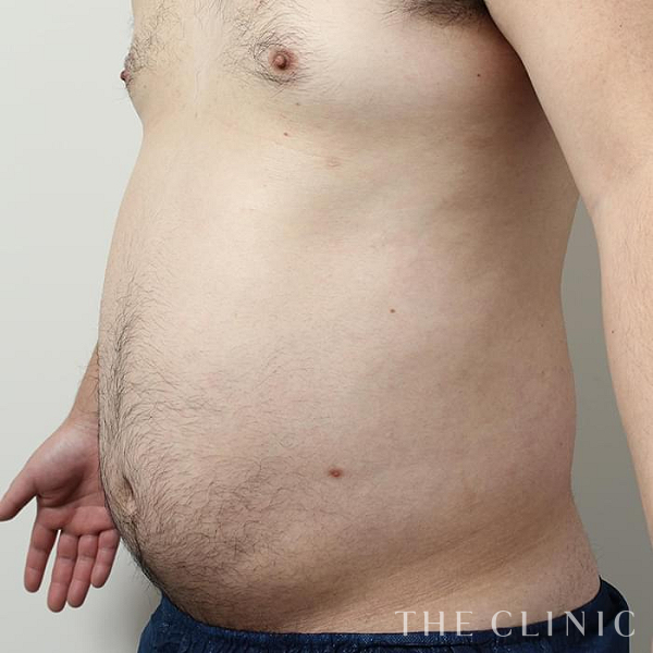 腹部の360脂肪吸引®（29歳男性）の術前写真