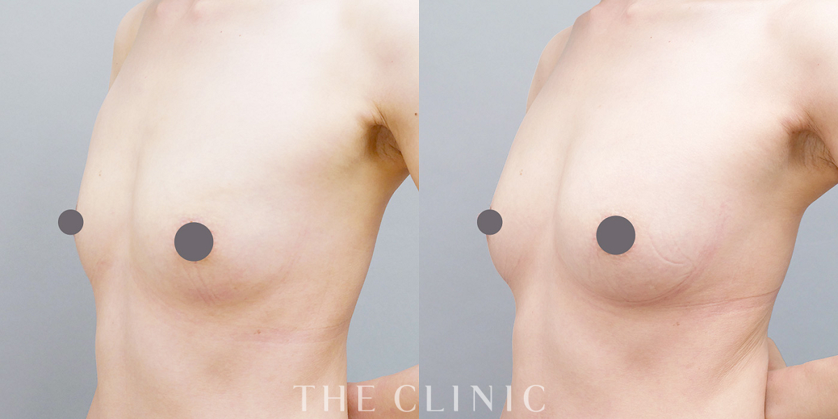 コンデンスリッチ豊胸の術前/術後