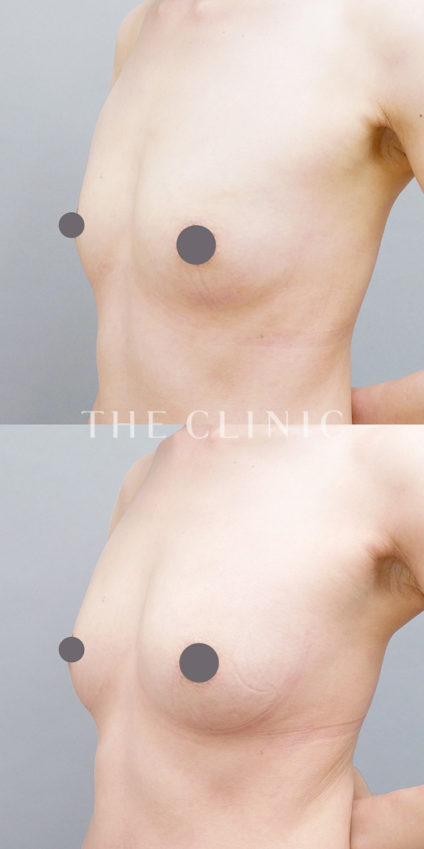 ボリュームアップのコンデンスリッチ豊胸（42歳女性）の術前・術後写真