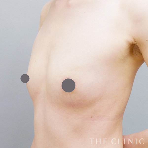 ボリュームアップのコンデンスリッチ豊胸（42歳女性）の術前写真