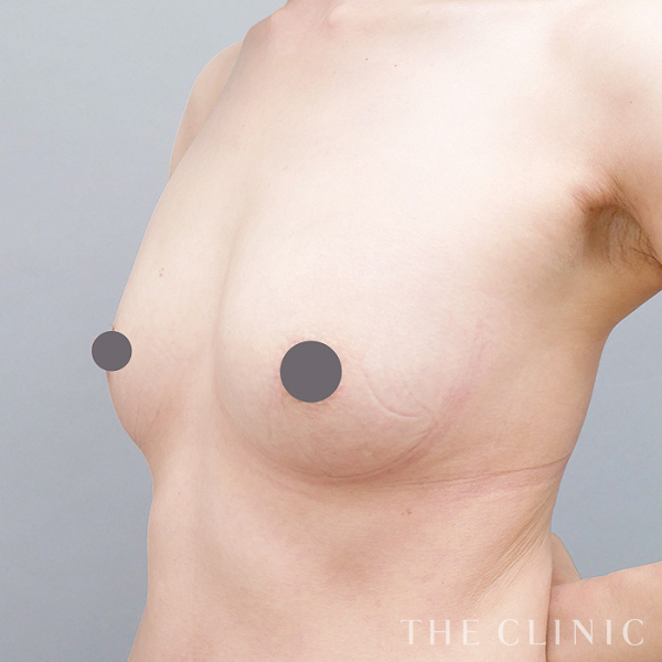 ボリュームアップのコンデンスリッチ豊胸（42歳女性）の術後写真