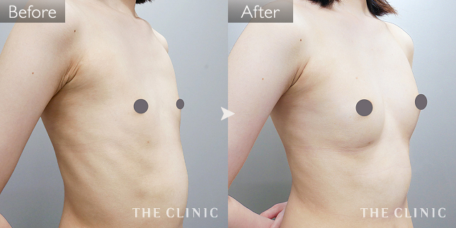 豊胸・胸の整形 ボリュームアップ 症例写真