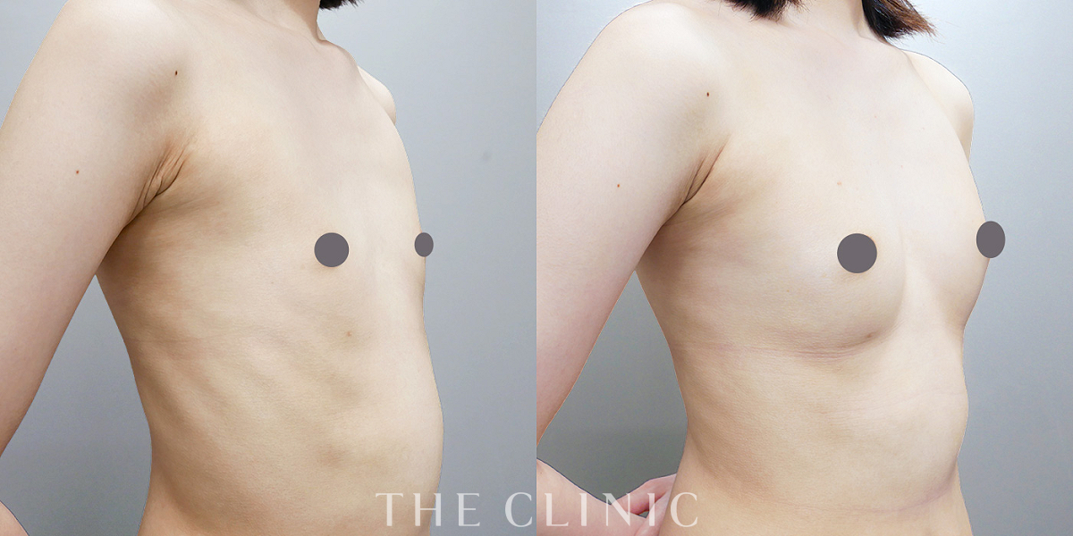 コンデンスビブラ豊胸の術前／術後