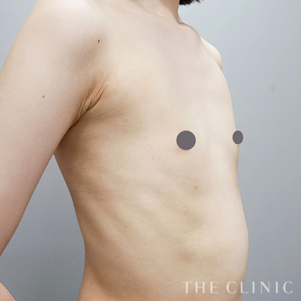 ボリュームアップのコンデンスビブラ豊胸（21歳女性）の術前写真