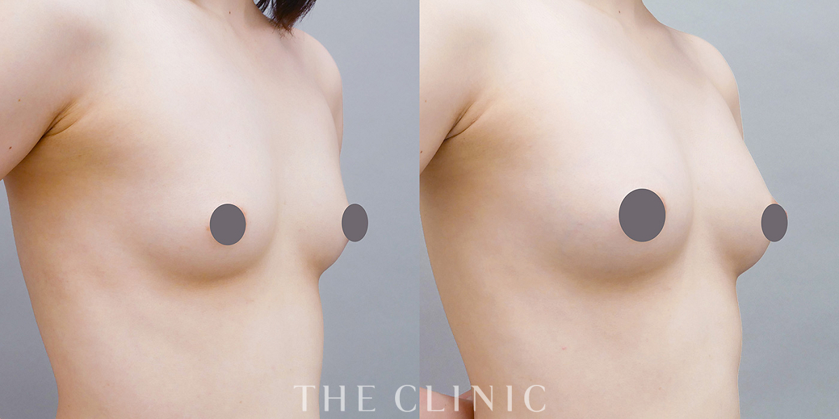 コンデンスリッチ豊胸の術前/術後