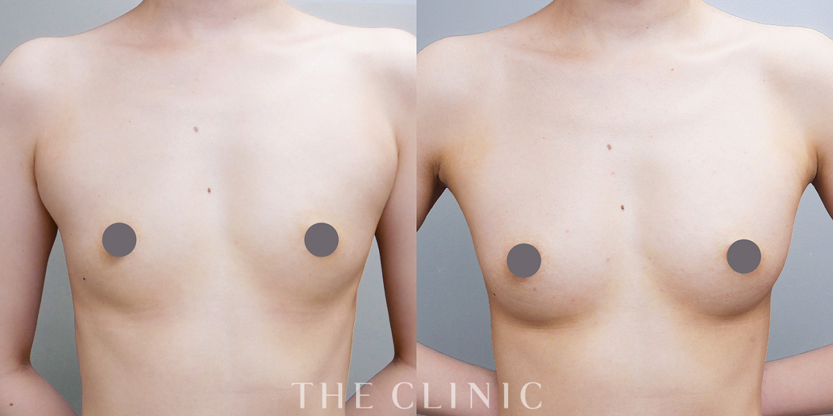 コンデンスリッチ豊胸の術前/術後