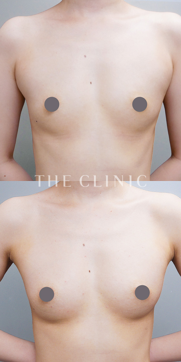 ボリュームアップのコンデンスリッチ豊胸（32歳女性）の術前・術後写真