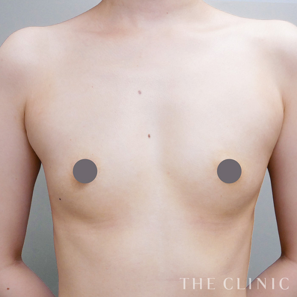 ボリュームアップのコンデンスリッチ豊胸（32歳女性）の術前写真