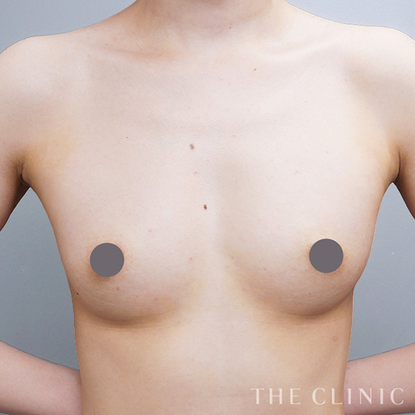 ボリュームアップのコンデンスリッチ豊胸（32歳女性）の術後写真