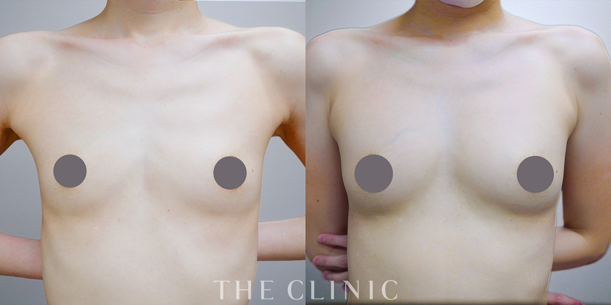 コンデンスリッチ豊胸の術前/術後