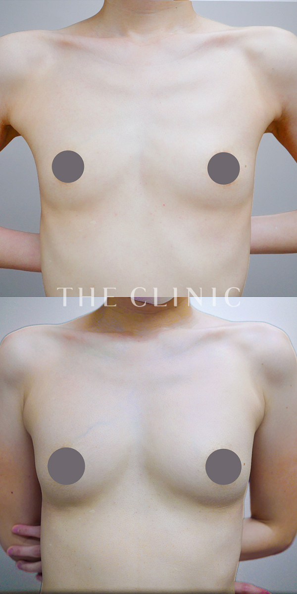 ボリュームアップのコンデンスリッチ豊胸（42歳女性）の術前・術後写真