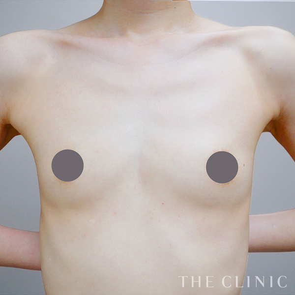 ボリュームアップのコンデンスリッチ豊胸（42歳女性）の術前写真