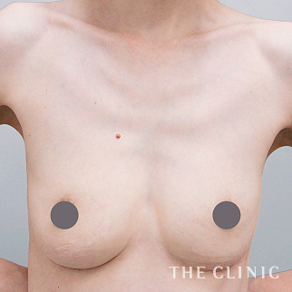 【THE CLINIC 症例画像】No.1579_2_不自然な形_豊胸シリコンバッグ除去(執刀医：木村 圭吾)