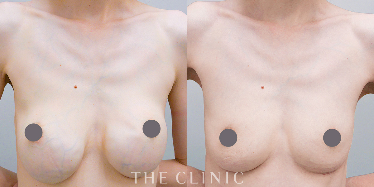 豊胸シリコンバッグ除去の術前／術後