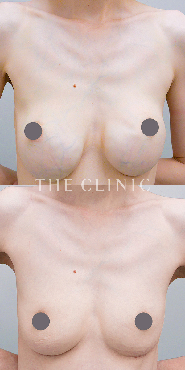 不自然な形の豊胸シリコンバッグ除去（39歳女性）の術前・術後写真