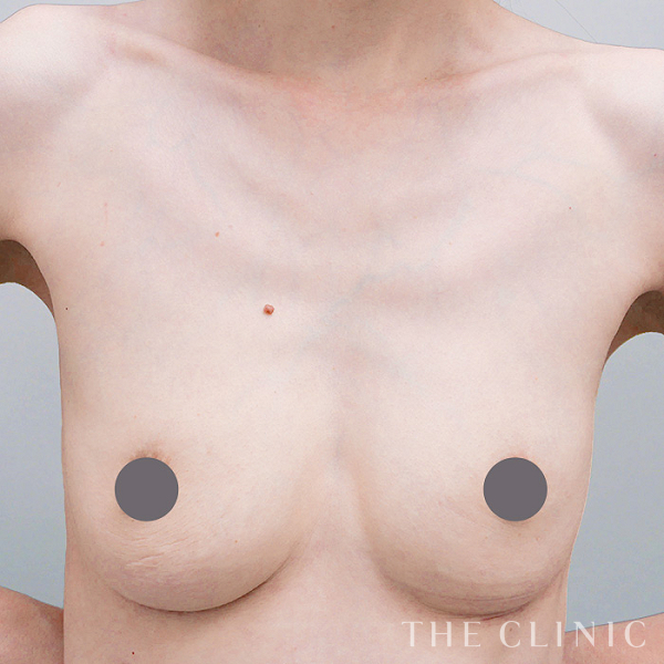 不自然な形の豊胸シリコンバッグ除去（39歳女性）の術後写真