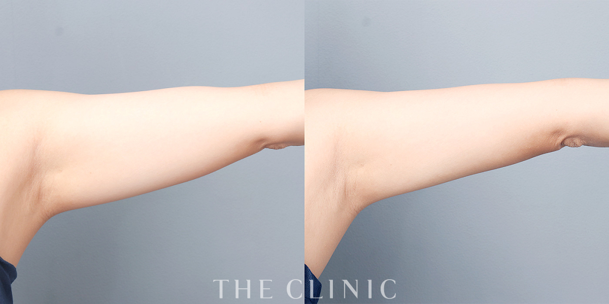 ベイザー脂肪吸引の術前/術後