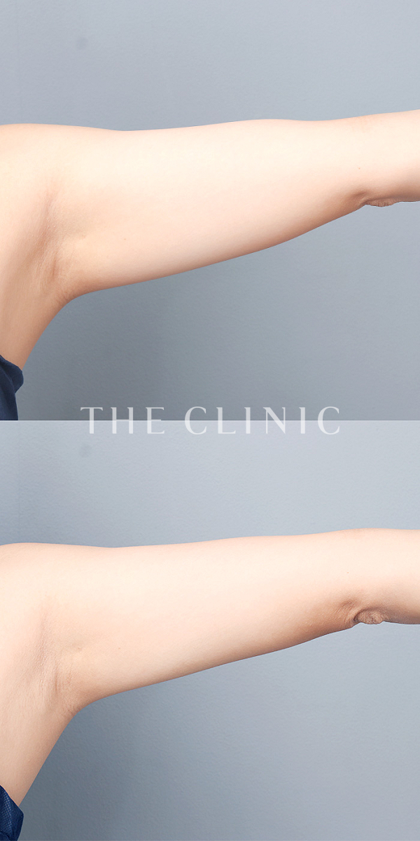 二の腕のベイザー脂肪吸引（30歳女性）の術前・術後写真