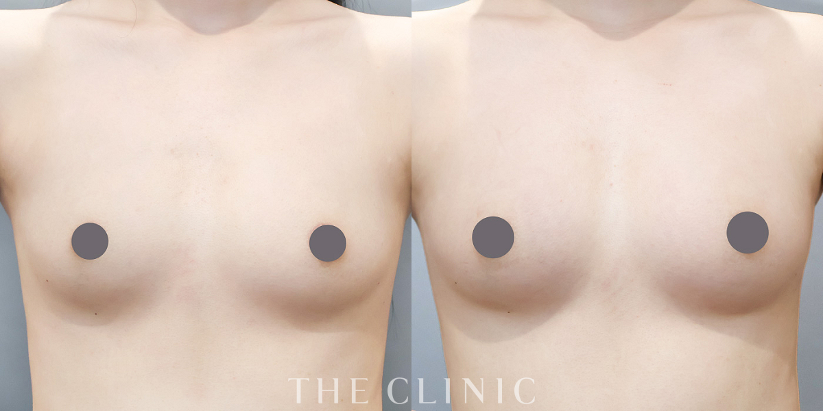 コンデンスリッチ豊胸の術前／術後