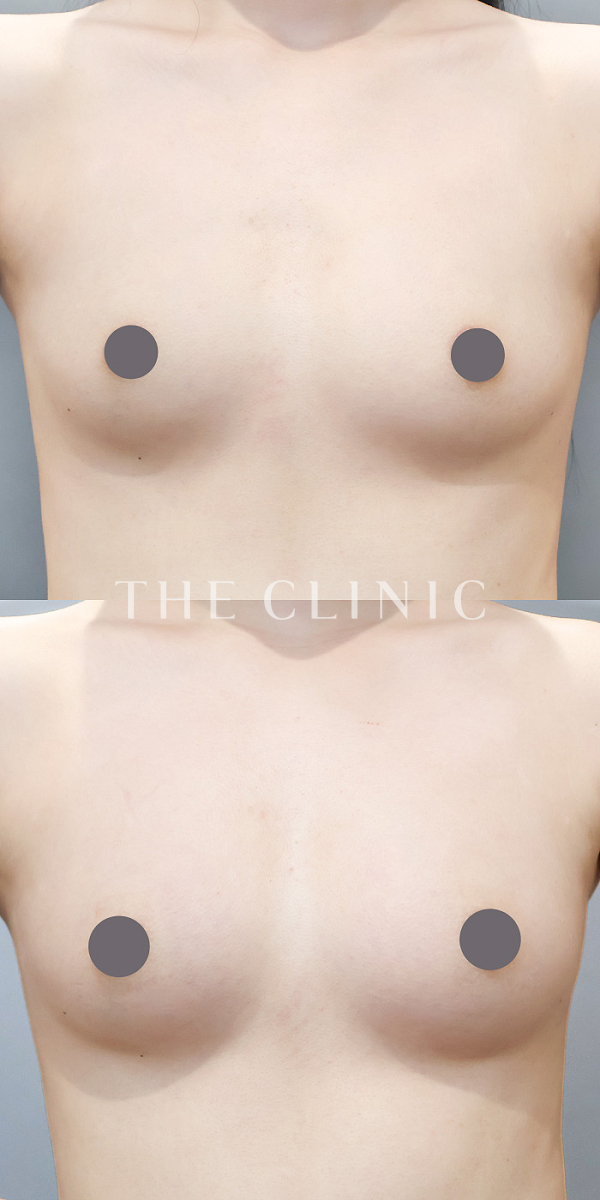 ボリュームアップのコンデンスリッチ豊胸（23歳女性）の術前・術後写真